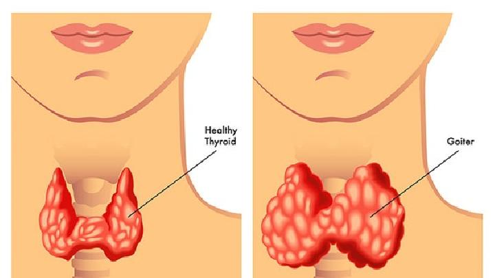 喉痈是怎么引起的？