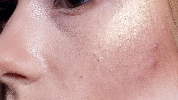 春季养生皮肤过敏怎么办最好皮肤过敏的两个要素要知道
