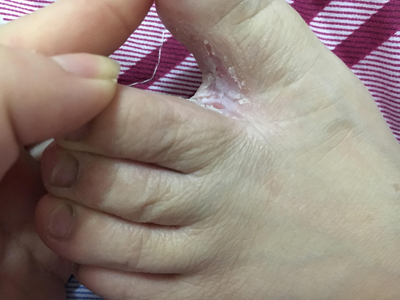 脚臭怎么治疗 臭脚的原因有哪