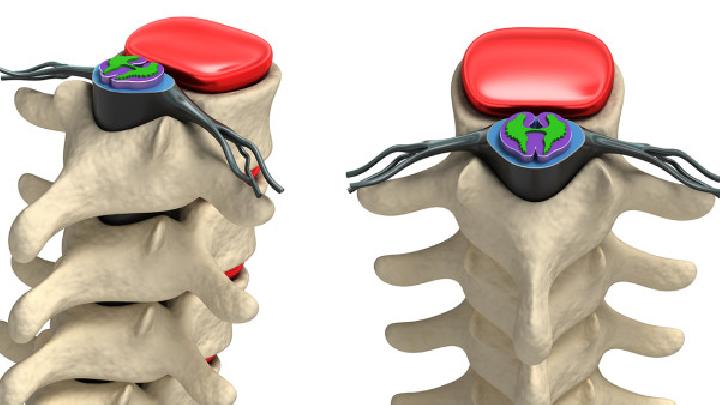 脊椎病患者的注意事项和锻炼方法
