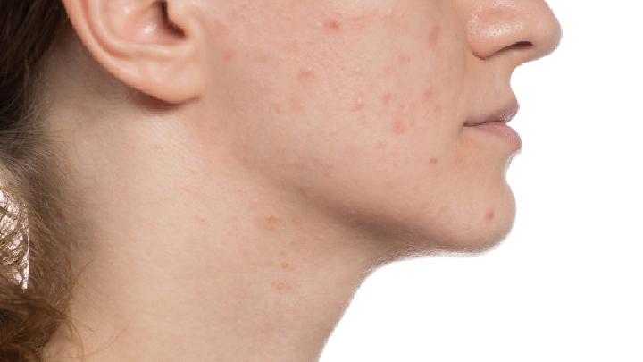 怎样才能防治好皮肤过敏?