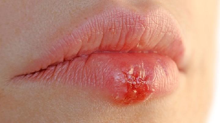 唇病是怎么引起的