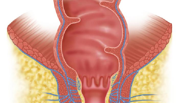 腹主动脉腔静脉瘘是怎么引起的？