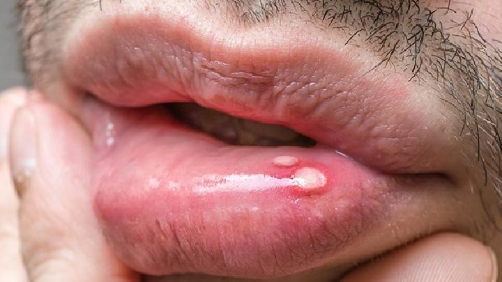 浆细胞性唇炎引发什么疾病