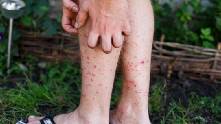 摩擦性苔藓样疹有哪些症状
