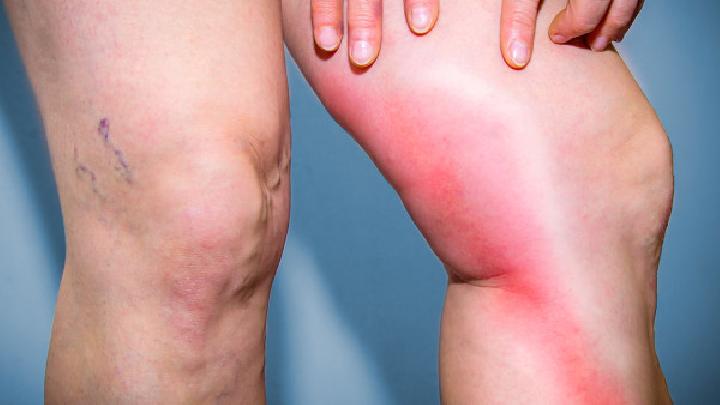 膝关节骨性关节炎有哪些症状？