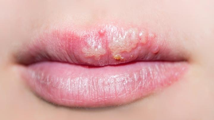 腺性唇炎如何预防？
