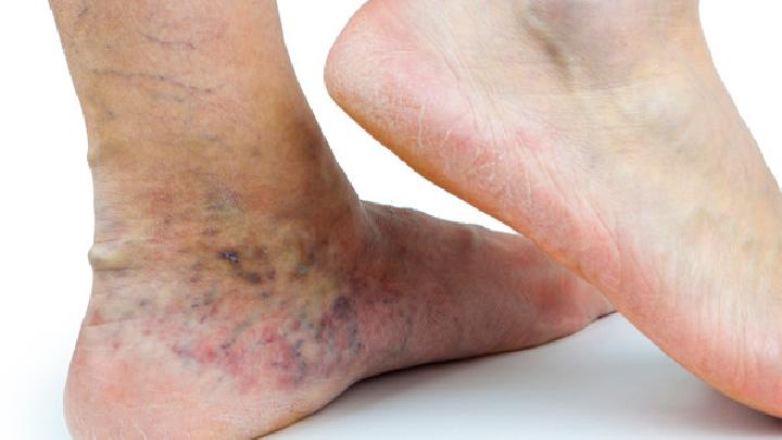 膝关节创伤性滑膜炎是怎么引起的？