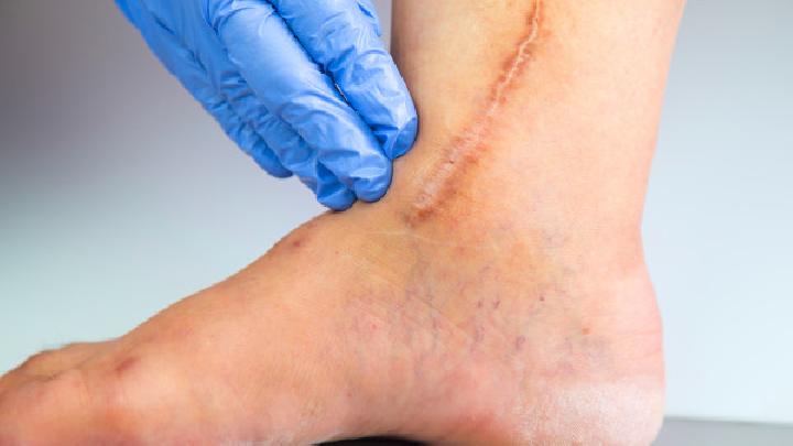 疤痕形成症状如何缓解和预防？