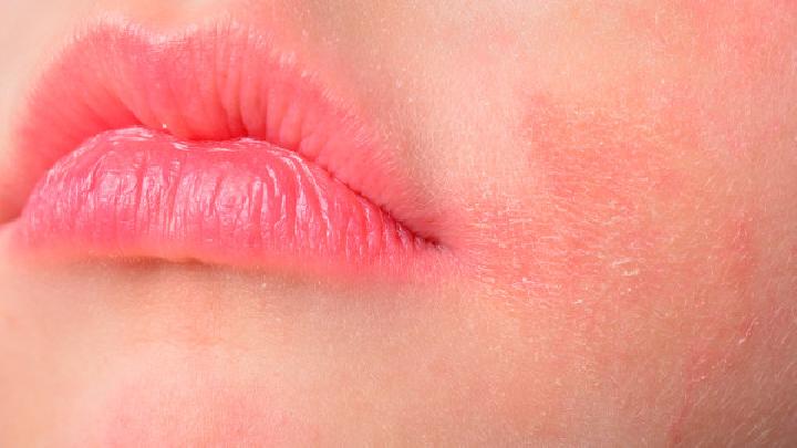 唇炎容易与哪些疾病混淆?