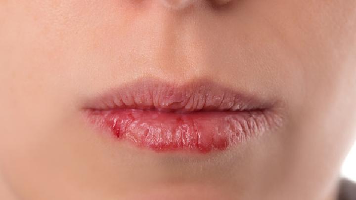腺性唇炎是由什么原因引起的？