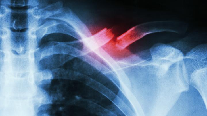 胸骨骨折容易与哪些疾病混淆？