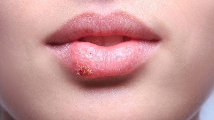 唇腭裂的最佳治疗时机是什么时候？