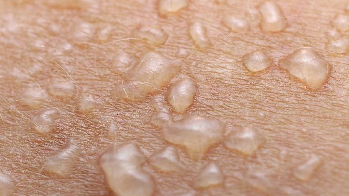 烫伤疤痕怎么去除?