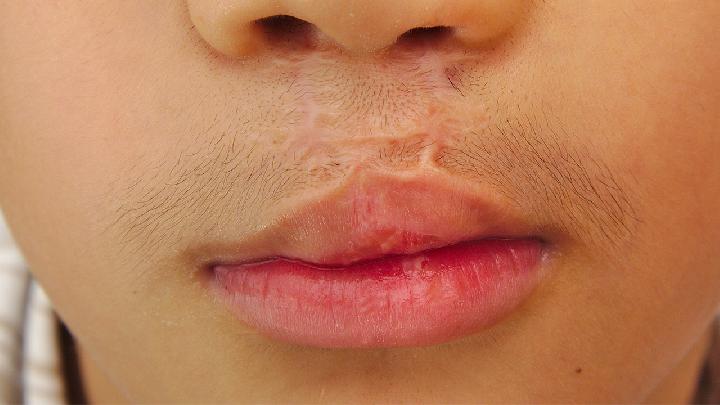 唇腭裂与遗传因素有关