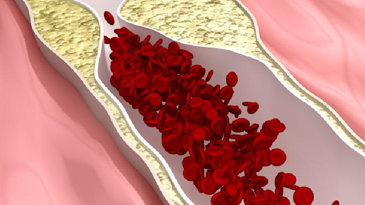 动脉粥样硬化患者的食疗方法