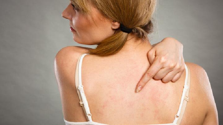 结节性痒疹是什么?