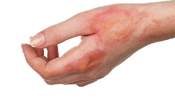 烧伤可能导致什么感染