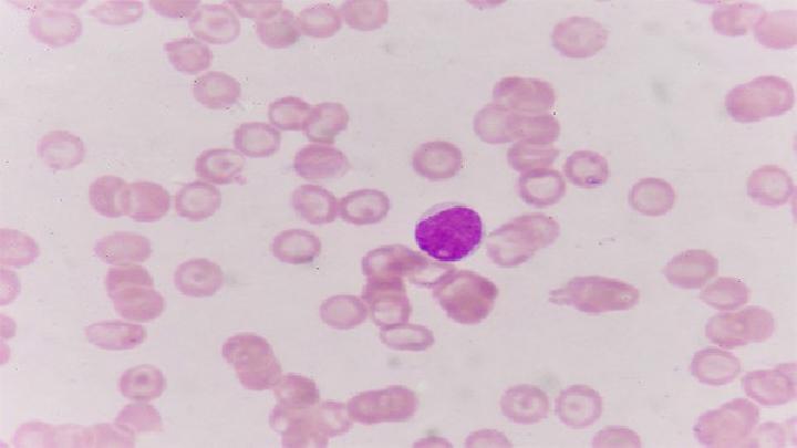 单纯疱疹病毒性巩膜炎容易与哪些疾病混淆？