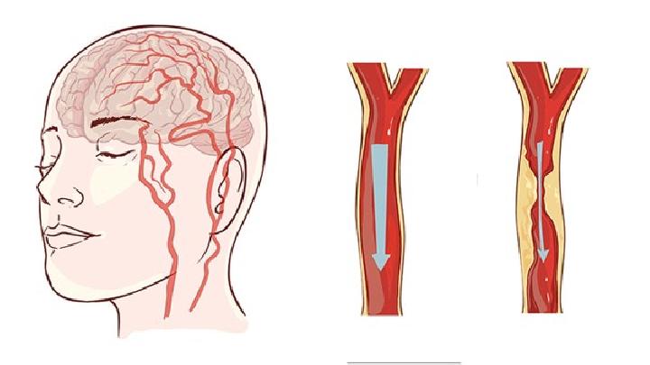 颅后窝血肿是由什么原因引起的？