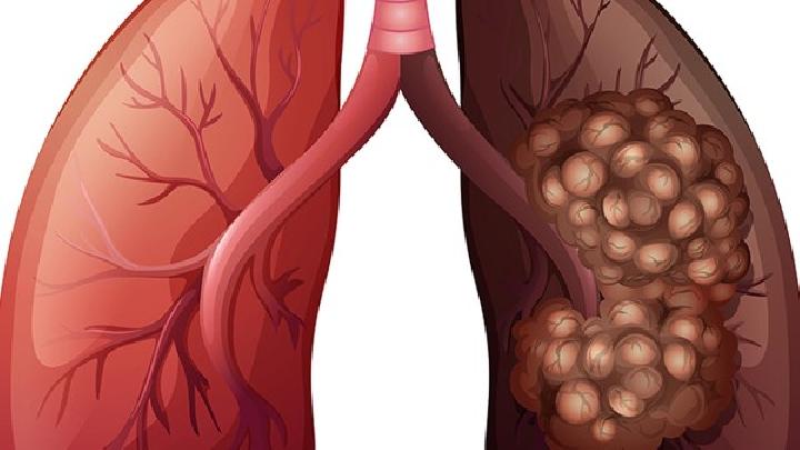 脾脏转移性肿瘤应该做哪些检查？