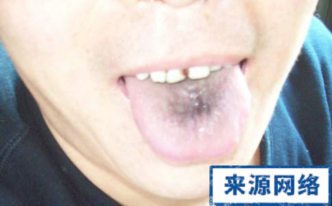 舌中心舌苔发黑什么原因引起的？（图片）