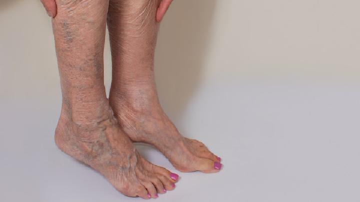 下肢静脉曲张的护理要点须知