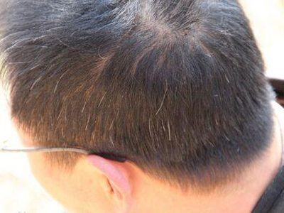 白发出现的原因究竟为何 你知道吗