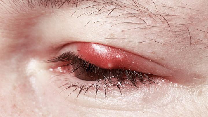 眼肿瘤有哪些症状？