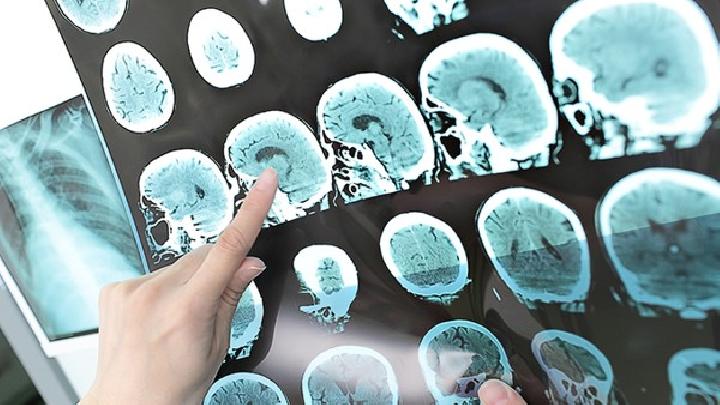 大脑凸面脑膜瘤有哪些症状？