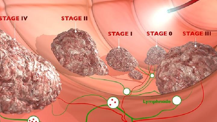 中枢神经系统肉芽肿性血管炎是由什么原因引起的？
