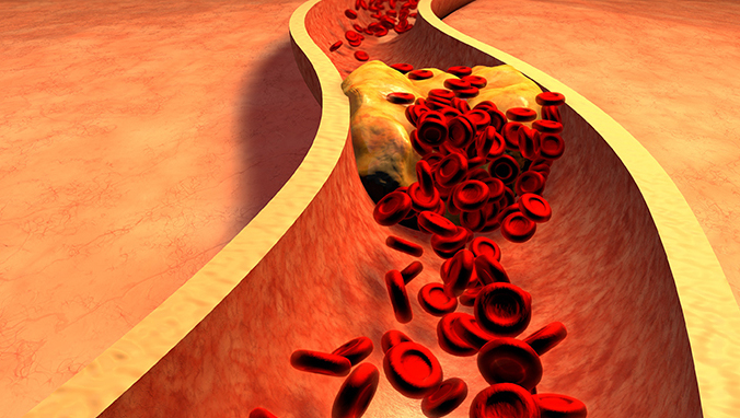 为什么会得下肢动脉硬化闭塞症