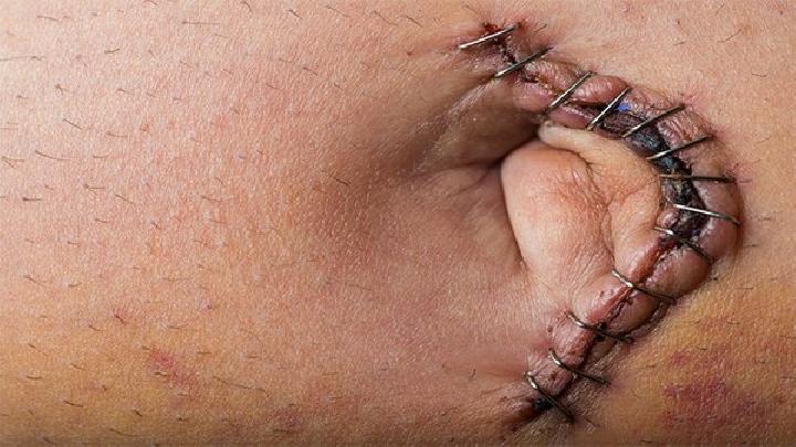 西医治疗手术疤痕的常规方法