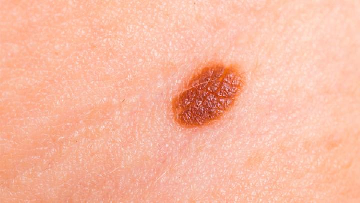 皮肤蝇蛆病是怎么引起的？
