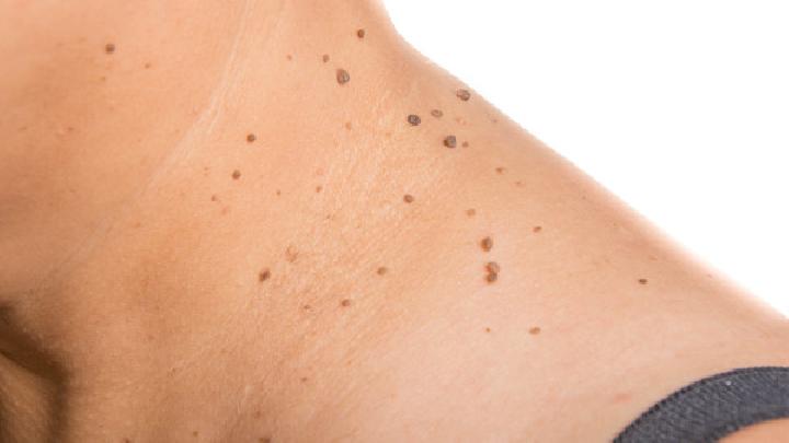 皮肤癣菌病的饮食保健