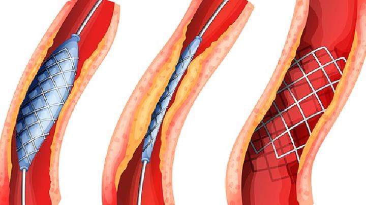 冠状动脉痉挛易导致什么并发症