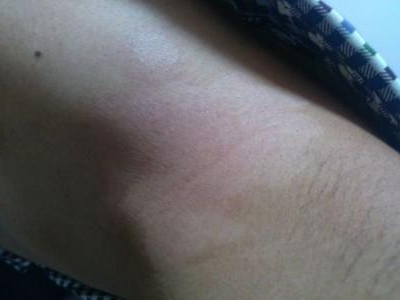 白癜风初期图片?