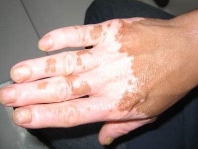 白癫风医生表示:初期白癜风极易与花斑癣,老年性白斑,晕痣等混淆,症状