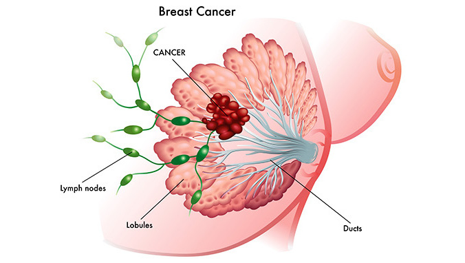 乳腺癌化疗的副作用