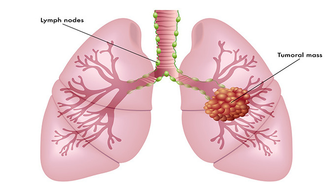 肺癌晚期全身痛怎么办