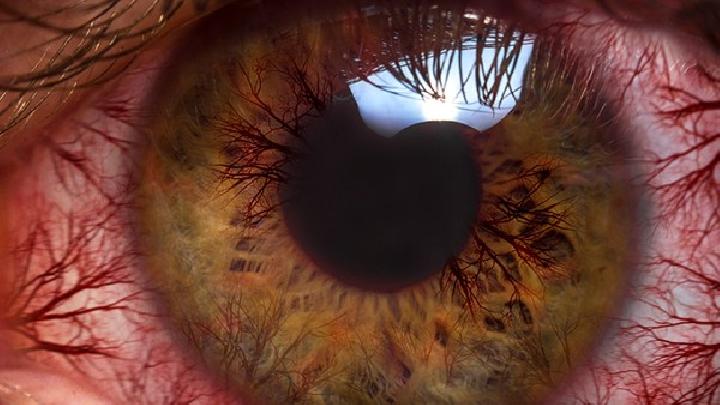 眼部的黑眼圈是怎么形成的?详细分析眼部黑眼圈的成因