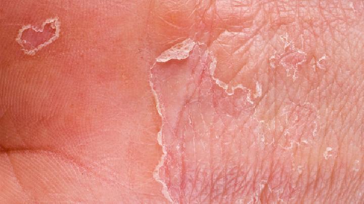 混合性皮肤怎么祛痘？混合性皮肤祛痘的方法有什么