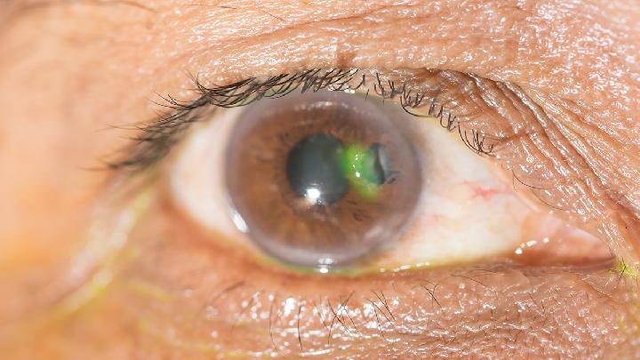 眼科疾病的自测方法出现这5种症状要多加注意