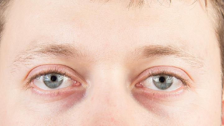 婴儿眼角红是怎么回事婴儿眼角红有什么危害吗