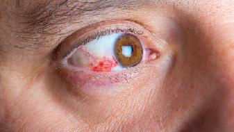 18种常见眼科疾病图片