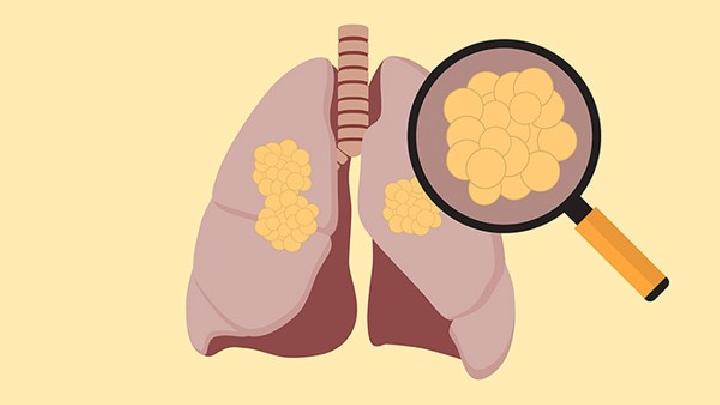 肺部CT可以检查什么疾病肺部CT可以查出这5种疾病