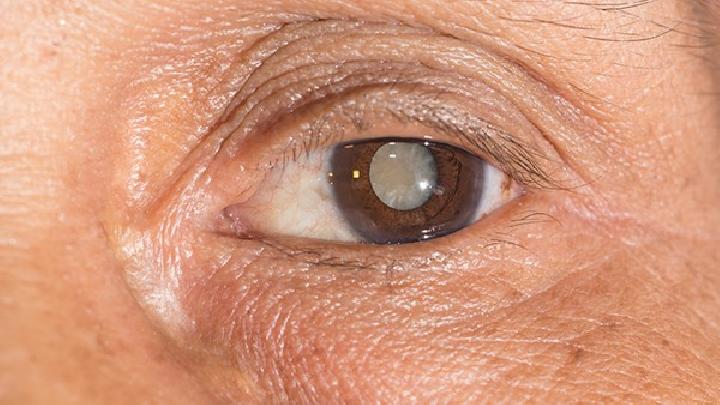 青光眼的初期症状出现这6种表现要及时就医
