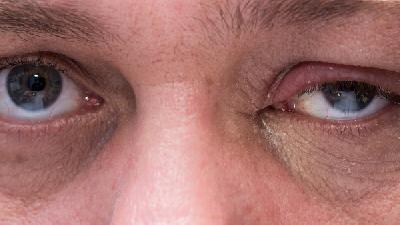 青光眼有什么症状 青光眼是因为眼压极速升高导致的吗