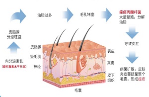 毛囊炎引起的细菌感染怎么办