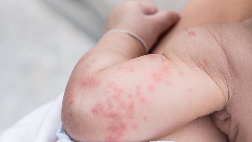 婴儿湿疹是怎么引起的，引发婴儿湿疹的三大诱因